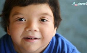 Image result for Person with Klinefelter Syndrome