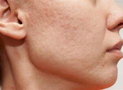 Image result for White Blemishes On Skin