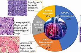 Image result for Small Cell Lung Cancer Prognosis