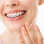 Image result for Smile with Ceramic Brackets