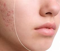 Image result for How to Remove Acne Scars