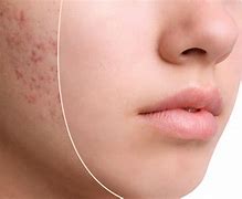 Image result for How to Get Rid of Pimple Scars