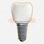Image result for Dental Implant Clip Art