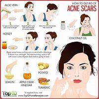 Image result for How to Remove Acne