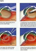 Image result for Cataract Surgery Cartoon