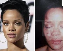 Image result for Rihanna After Chris Brown Assault