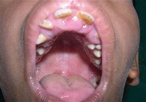 Image result for Goldenhar Syndrome