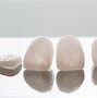 Image result for temporary veneers for teeth