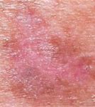 Image result for Pink Melanoma