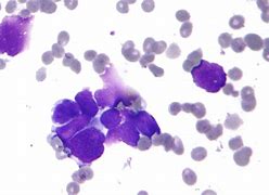 Image result for Stage 4 Blood Cancer
