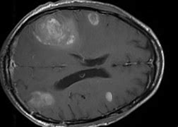 Image result for Stage 4 Metastatic Brain Cancer