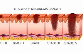 Image result for Stage 4 Cancer