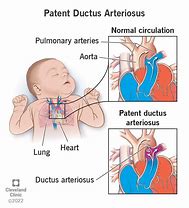 Image result for Patent Ductus Arteriosus