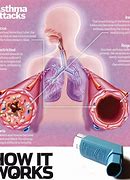 Image result for Inhaler Asthma Attack