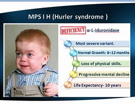 Image result for Hurler Syndrome Eye