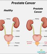 Image result for Prostate Cancer