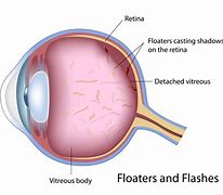 Image result for Shapes of Eye Floaters