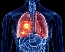 Image result for Advanced Stage 4 Lung Cancer