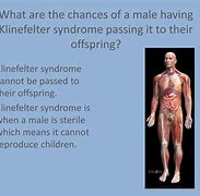 Image result for Klinefelter's Syndrome Health Risks