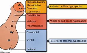 Image result for Hypospadias Pictures Man