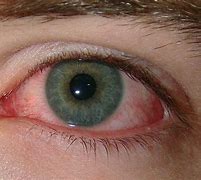 Image result for Scratched Eye Healing Time