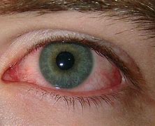 Image result for Scratched Eye Under Black Light