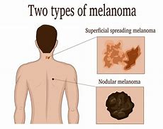 Image result for Nodular Melanoma Cancer