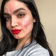 Image result for Pretty Girl with Acne Scars