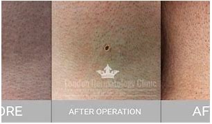 Image result for Skin Tag After Removal