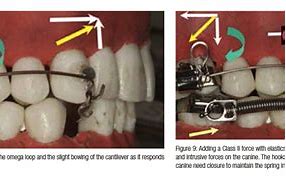 Image result for Cantilever Mechanics Orthodontics