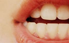 Image result for Blanchiment De Dents
