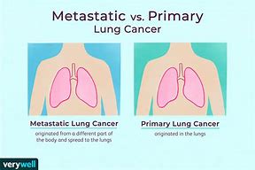 Image result for Lung Cancer Metastasis Symptoms