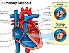 Image result for Noonan Syndrome Heart