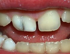 Image result for Iced Out Grillz Teeth