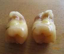 Image result for Wisdom Teeth Problem