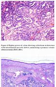 Image result for T Stage of Colon Cancer