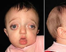 Image result for Pfieffer Syndrome Type 2 Pictures of S