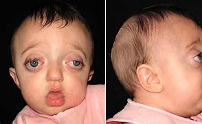 Image result for Pfeiffer Syndrome Prince Baby