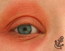 Image result for Eyes Burning Allergies