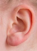 Image result for Ear Cancer