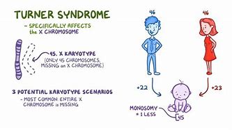Image result for Turner Syndrome Genes