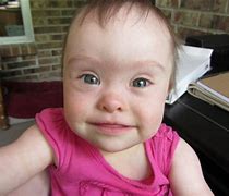 Image result for People with Down Syndrome