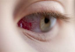 Image result for Scratched My Eye