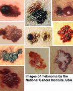 Image result for Melanoma Cancer in Black People