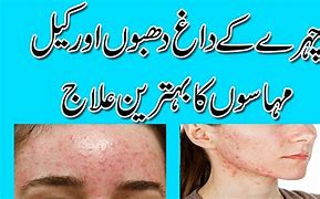 Image result for How to Remove Pimples Overnight