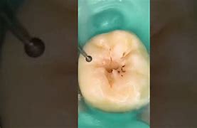 Image result for Dentist Clean Teeth