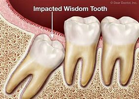 Image result for Wisdom Tooth Extraction