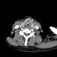 Image result for Stage 4 Laryngeal Cancer