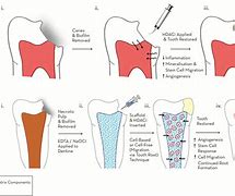Image result for Restorative Dentistry Procedure