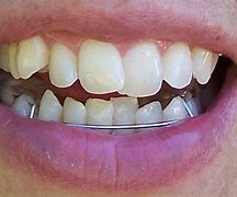 Image result for Polident Retainer Cleaner